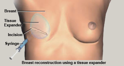 [Breast reconstruction using a tissue expander]